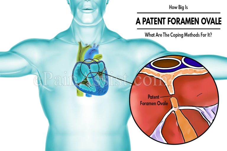 How Big Is A Patent Foramen Ovale & What Are The Coping Methods For It?
