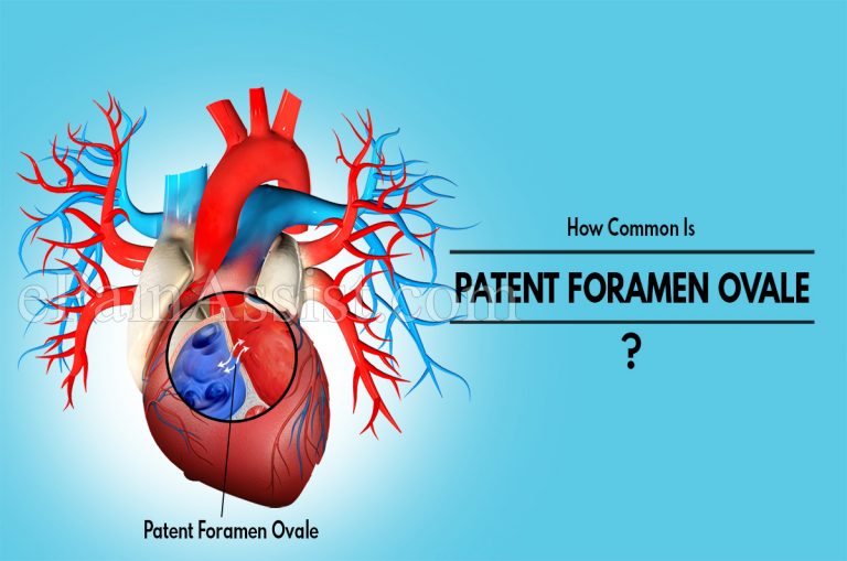 How Common Is Patent Foramen Ovale Or Is It A Rare Disease & Is There A Surgery For PFO?