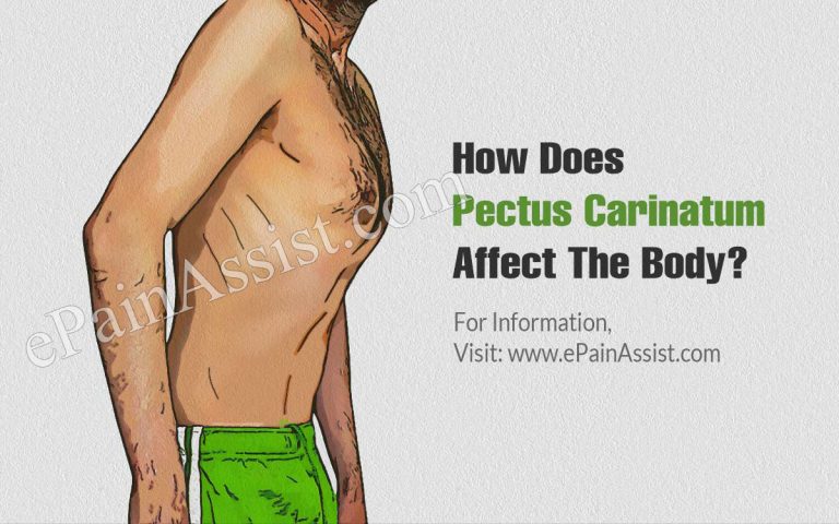 How Does Pectus Carinatum Affect The Body & What Triggers It & Is It A Disability?