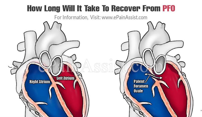 How Long Will It Take To Recover From PFO & How Long Do The Symptoms Last?