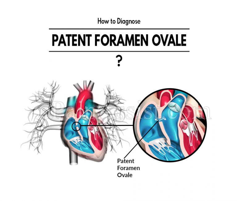 How to Diagnose Patent Foramen Ovale & What Is The Best Medicine For It?