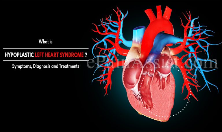 What is Hypoplastic Left Heart Syndrome : Risk Factors, Symptoms, Diagnosis and Treatments