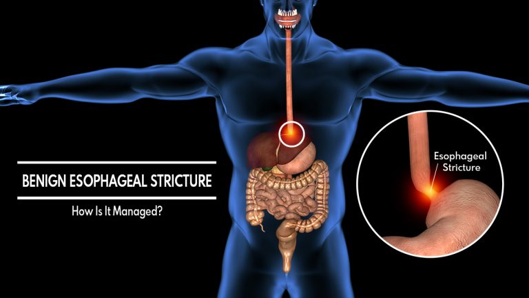 What Are The Presenting Features Of Benign Esophageal Stricture & How Is It Managed?