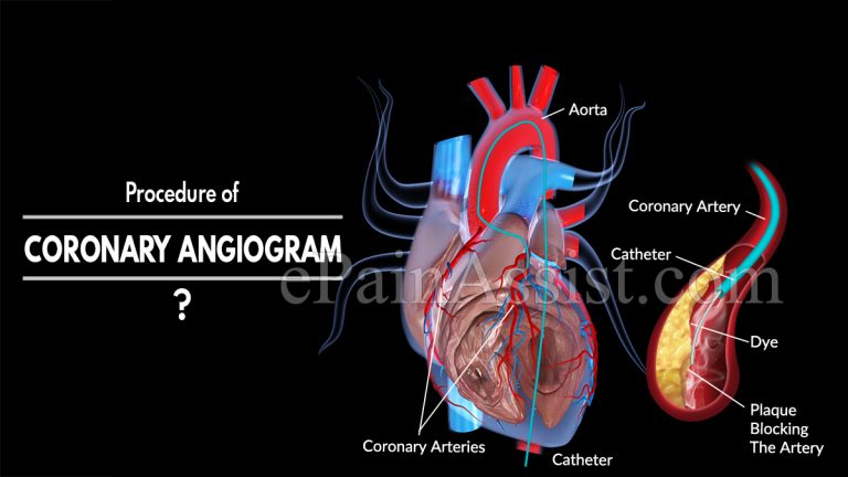 Procedure of Coronary Angiogram