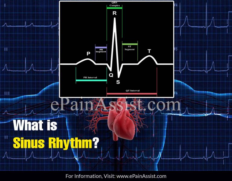What is Sinus Rhythm?