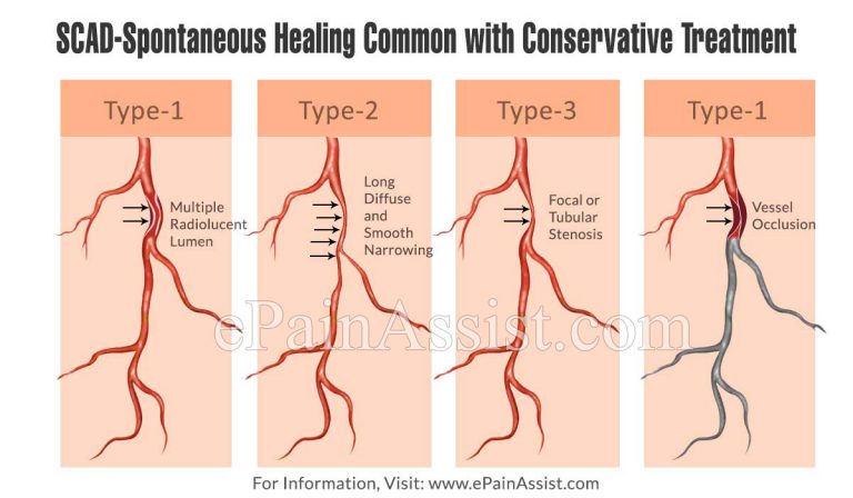 SCAD-Spontaneous Healing Common with Conservative Treatment