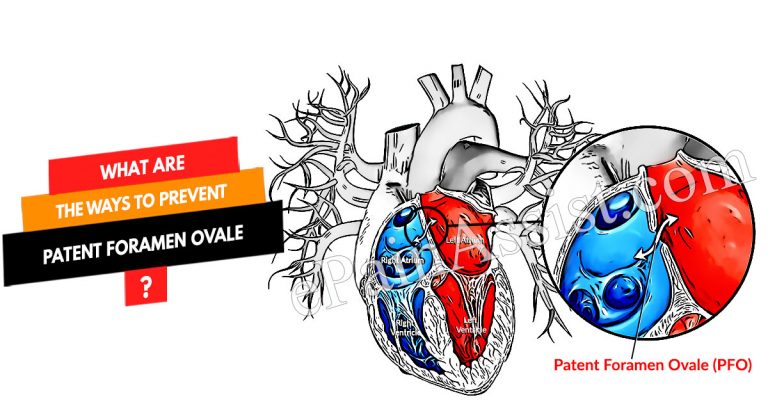 What Are The Ways To Prevent Patent Foramen Ovale & Does It Reoccur?