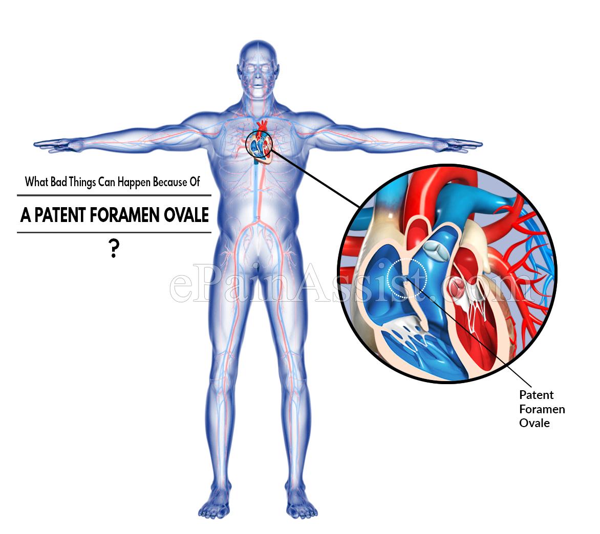 What Bad Things Can Happen Because Of A Patent Foramen Ovale?