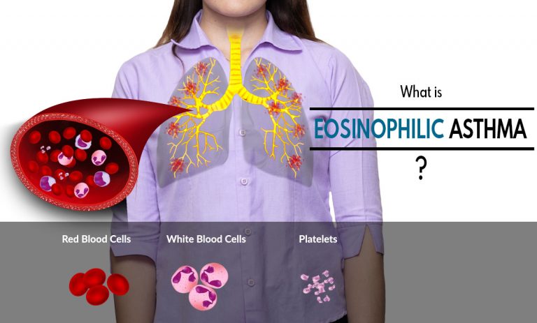 What is Eosinophilic Asthma, Know its Causes, Symptoms, Treatments, Prognosis