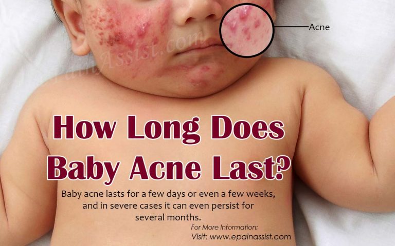 What are the Causes of Baby Acne & How Long Does Baby Acne Last?|Do’s & Don’ts of Baby Acne