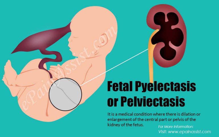 What is Fetal Pyelectasis or Pelviectasis: Diagnosis, Treatment, Association with Down Syndrome