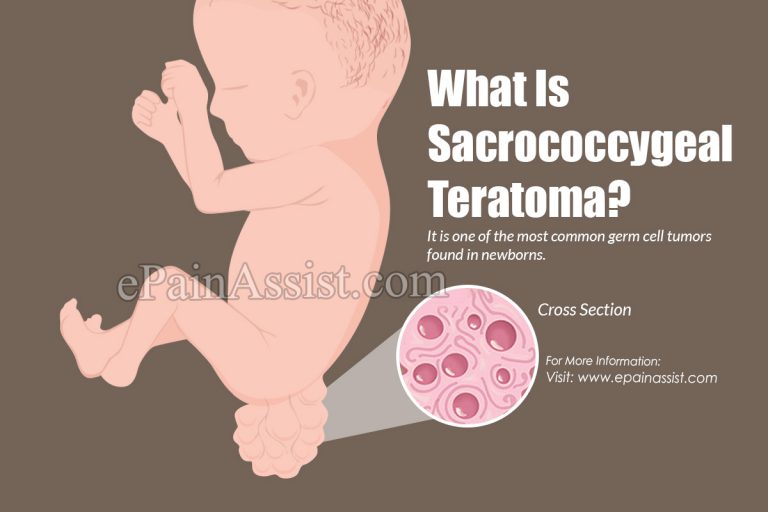 Sacrococcygeal Teratoma: Causes, Symptoms, Treatment