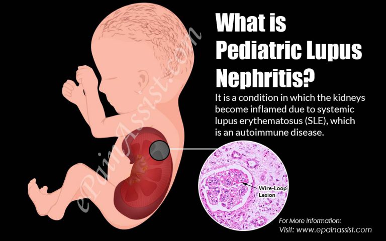What is Pediatric Lupus Nephritis: Causes, Symptoms, Types, Treatment, Diagnosis