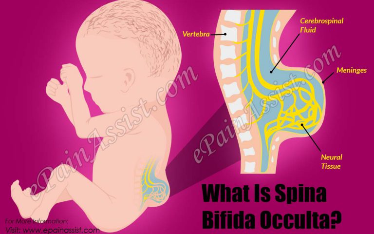 What is Spina Bifida Occulta: Causes, Symptoms, Treatment, Prognosis, Diagnosis