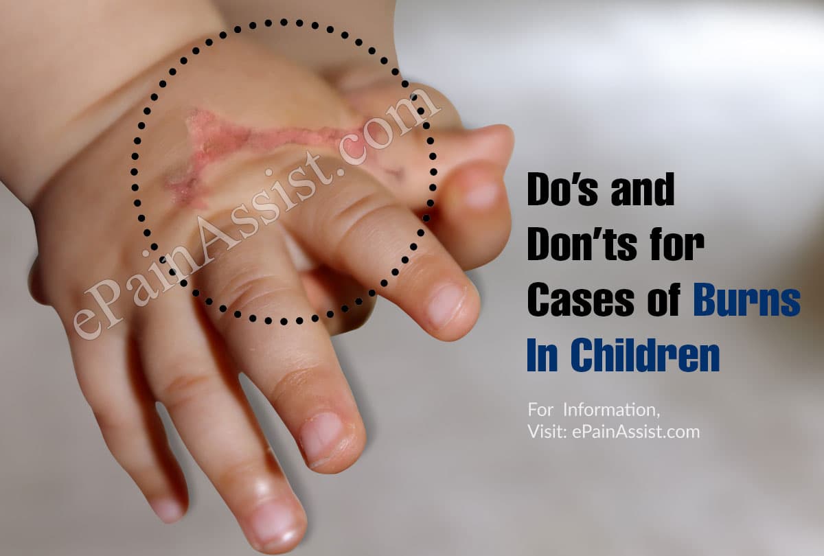 Do’s and Don’ts for Cases of Burns In Children