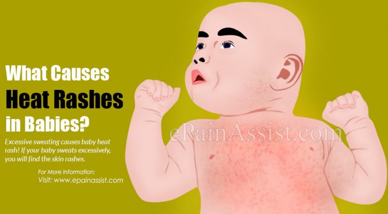 What Causes Baby Heat Rash & What Is Its Treatment, Prevention?
