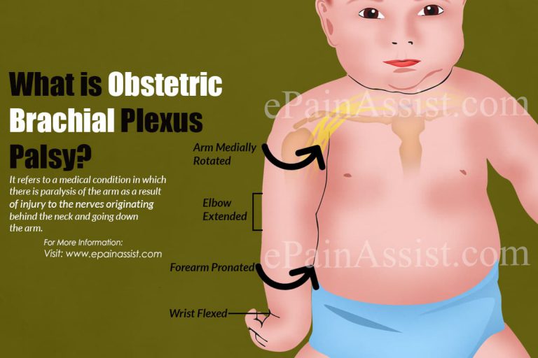 What is Obstetric Brachial Plexus Palsy & How is it Treated?|Causes, Symptoms, Prognosis of  Obstetric Brachial Plexus Palsy