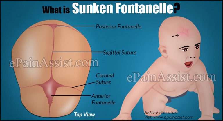 What is Sunken Fontanelle: Symptoms, Causes, Treatment, Diagnosis