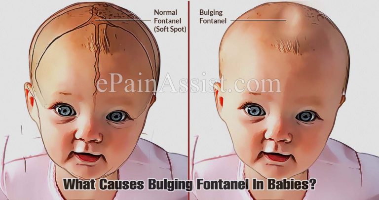 Bulging Fontanel In Babies