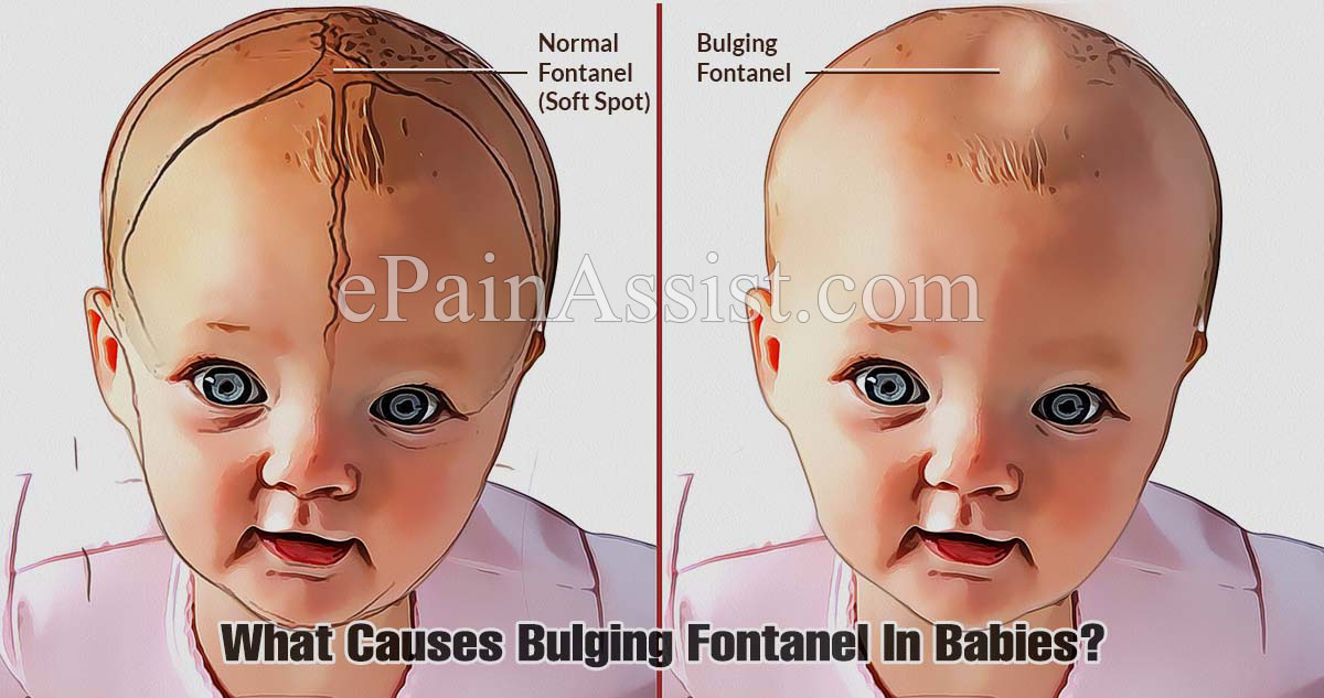 Fontanelle Bulging Vs Sunken What Causes A Bulging Anterior 