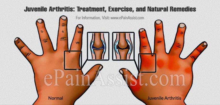 Juvenile Arthritis: Treatment, Exercise, and Natural Remedies