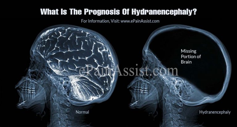 What is Hydranencephaly: Causes, Symptoms, Treatment, Prognosis