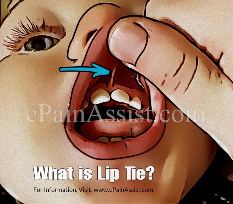 What is Lip Tie, Know its Symptoms, Treatments, and How To Breastfeed A Baby With A Lip Tie?