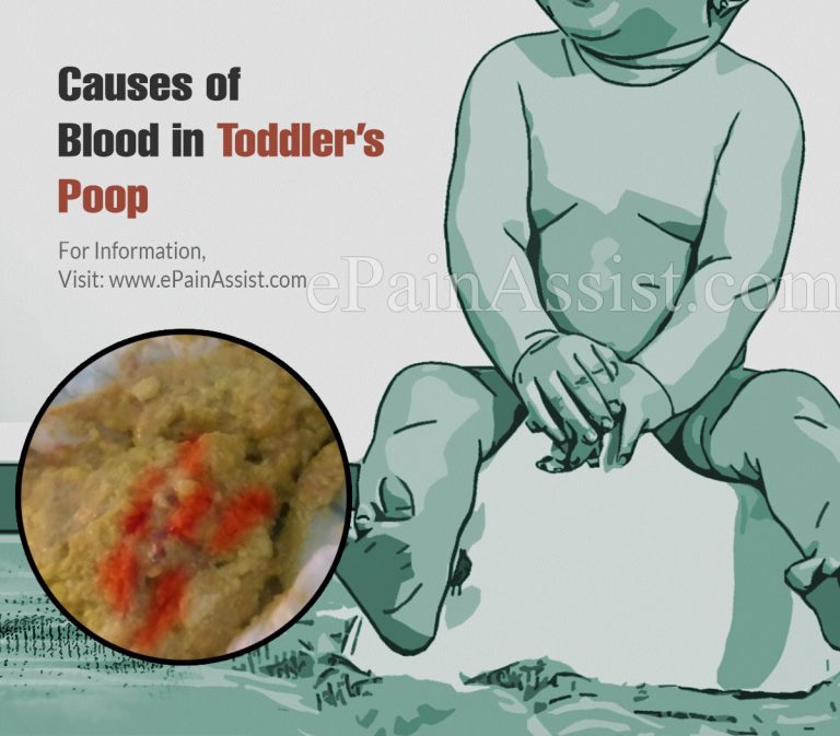 Blood In Toddler’s Poop: Causes, Symptoms, Treatment