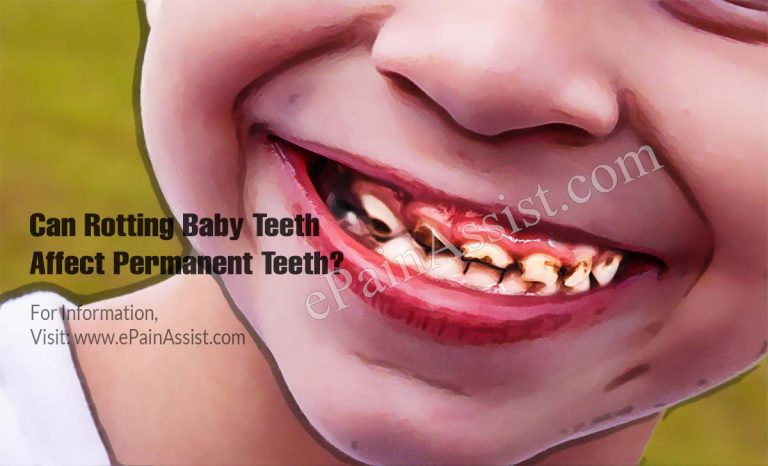 Can Rotting Baby Teeth Affect Permanent Teeth & What Is Its Treatment?