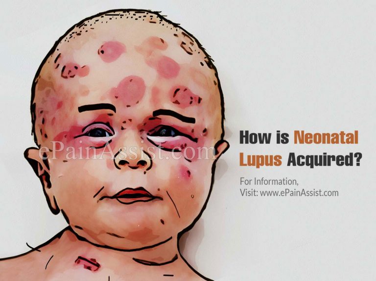How is Neonatal Lupus Acquired & What is its Treatment?