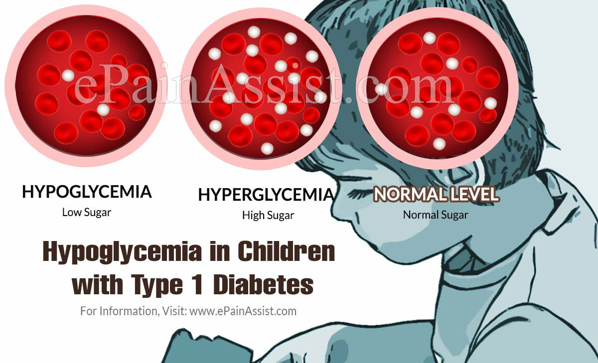 Hypoglycemia in Children with Type 1 Diabetes