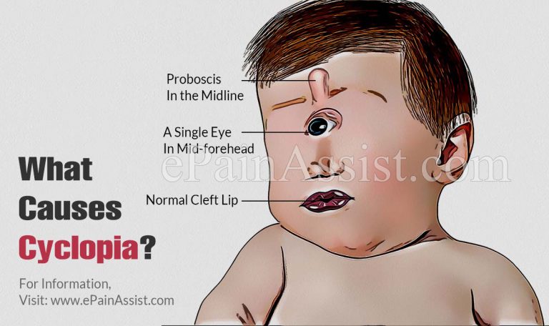 Cyclopia: Causes, Symptoms, Life Expectancy