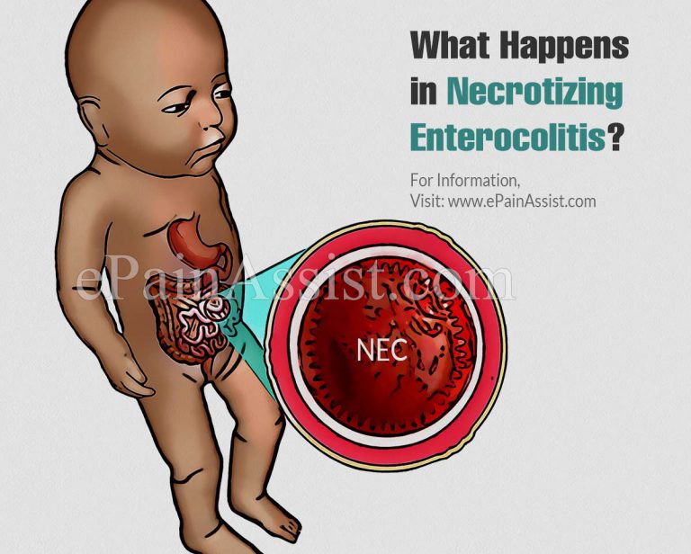 What Happens in Necrotizing Enterocolitis & When Can The Baby Suffering From Necrotizing Enterocolitis Start On Normal Feedings?