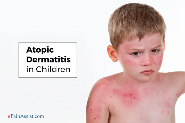 Atopic Dermatitis in Children: Symptoms, Causes, Diagnosis, Treatment, Home Remedies