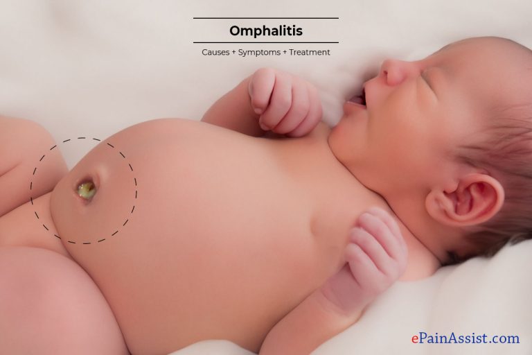 Omphalitis : Causes, Symptoms, Treatment, and Prevention