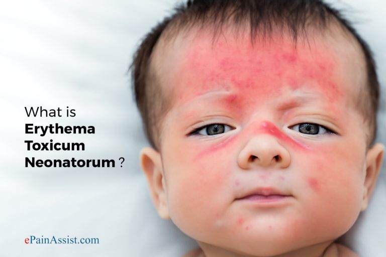 What is Erythema Toxicum Neonatorum & How is it Treated : Causes, Symptoms, and Prevention of Erythema Toxicum Neonatorum