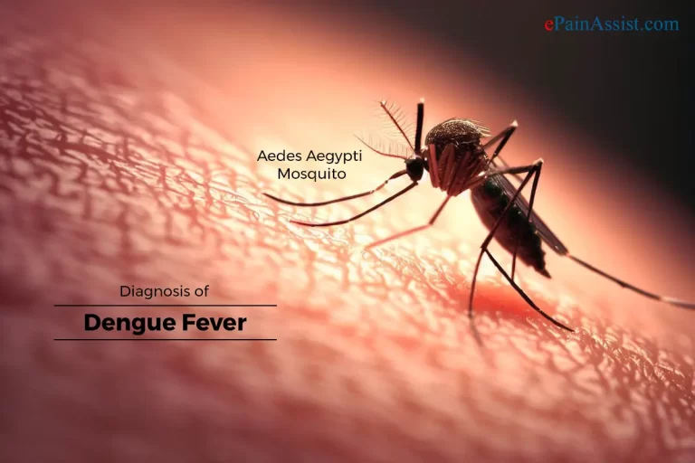 Dengue Fever Lymphadenopathy: Causes, Symptoms, Treatment