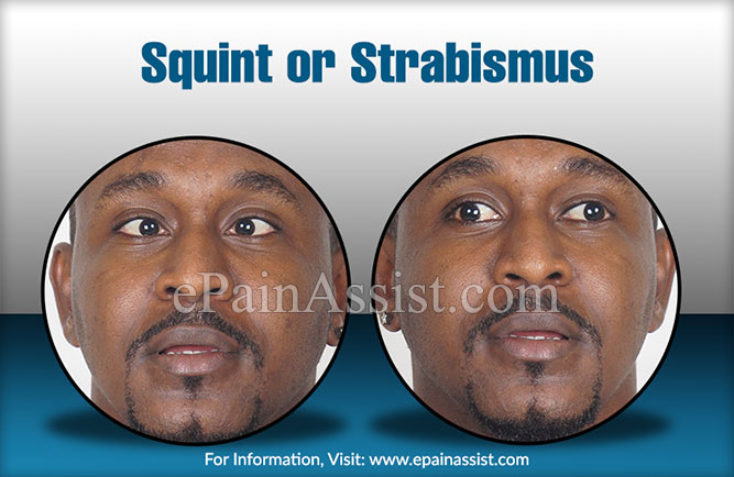 Squint or Strabismus
