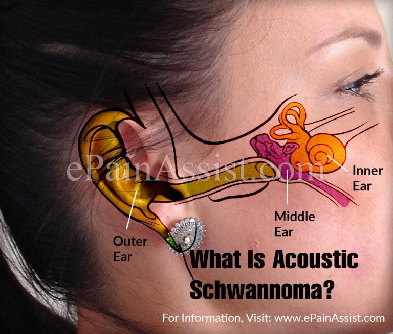 Acoustic Schwannoma or Vestibular Schwannoma : Causes, Symptoms, Treatment, Diagnosis