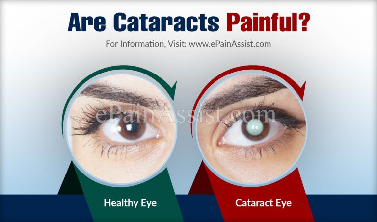 Are Cataracts Painful?