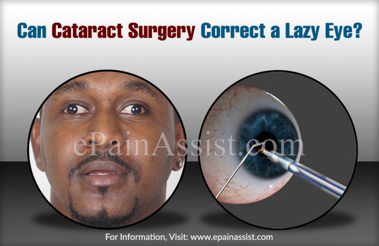 Can Cataract Surgery Correct a Lazy Eye?