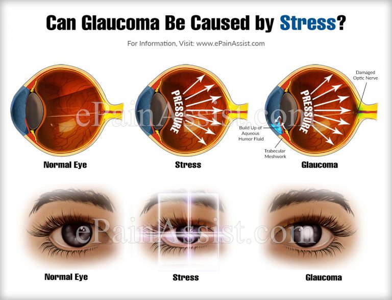 Can Glaucoma Be Caused by Stress?