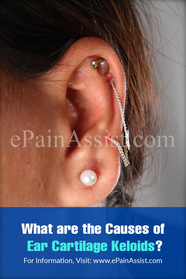 Causes Of Ear Cartilage Keloid & Ways To Get Rid Of It
