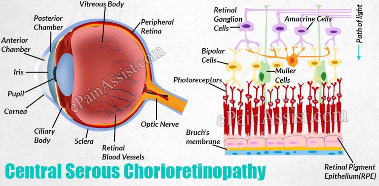 Central Serous Chorioretinopathy: Symptoms, Who is at Risk, Treatment, Diagnosis