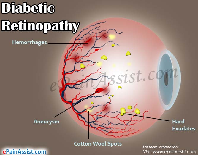 Diabetic Retinopathy