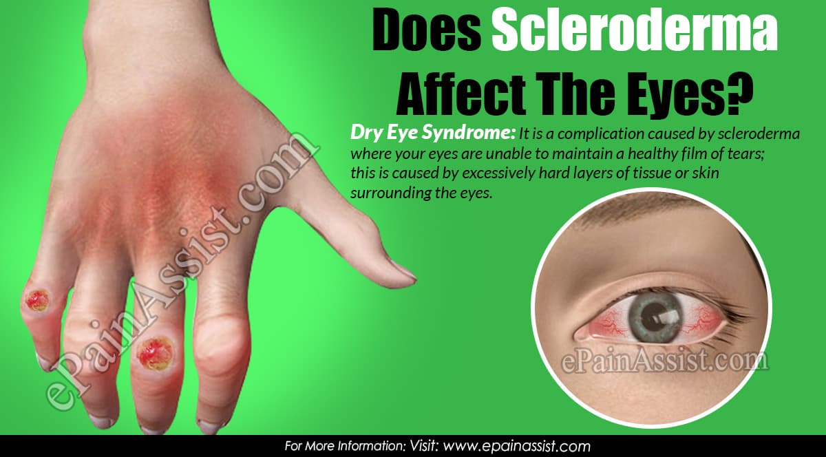 Does Scleroderma Affect The Eyes?