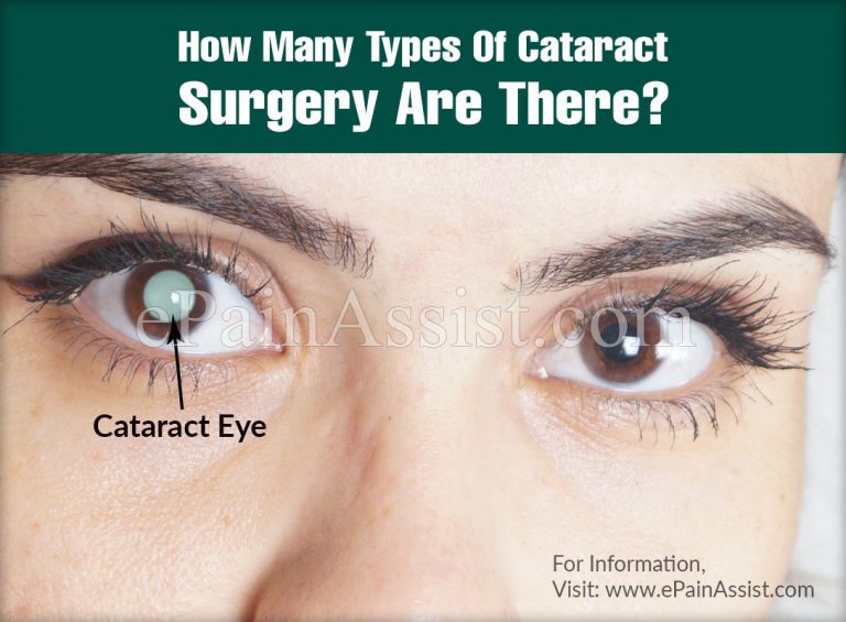 How Many Types Of Cataract Surgery Are There?