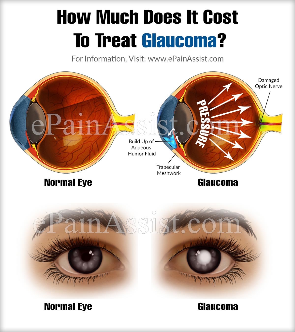 How Much Does It Cost To Treat Glaucoma?