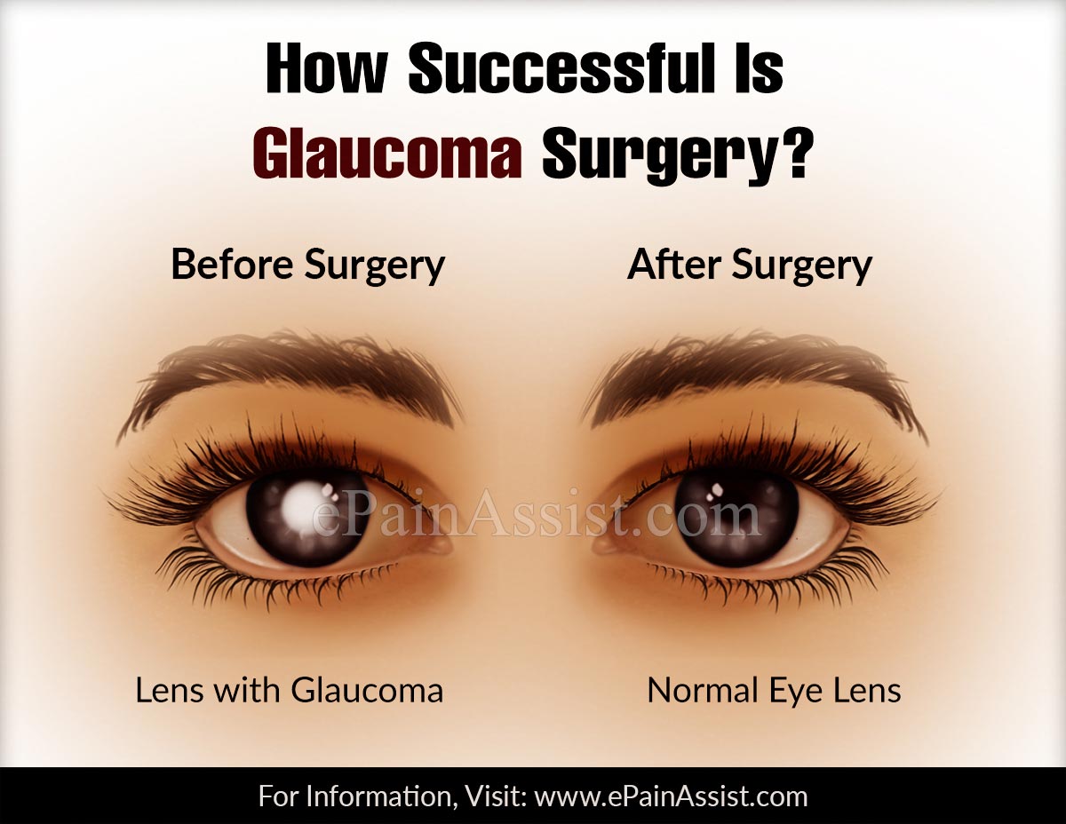 How Successful Is Glaucoma Surgery?