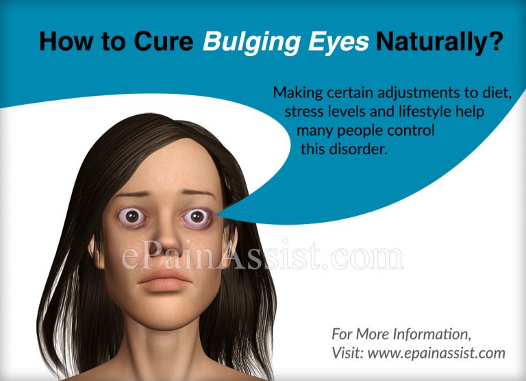 How to Cure Bulging Eyes Naturally?